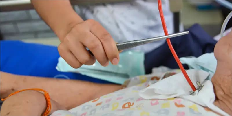 Tracheostomy Management